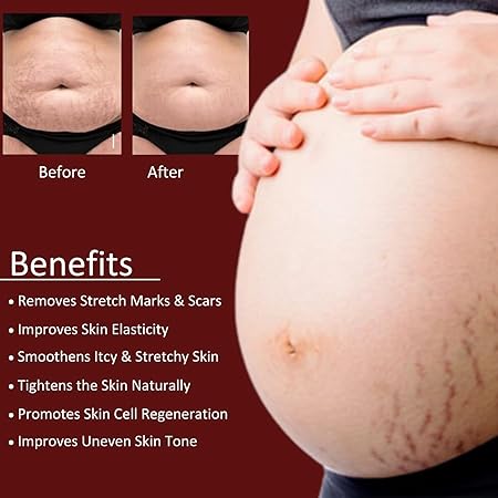 Stretch Mark Repair Cream for Radiant, Smooth Skin"