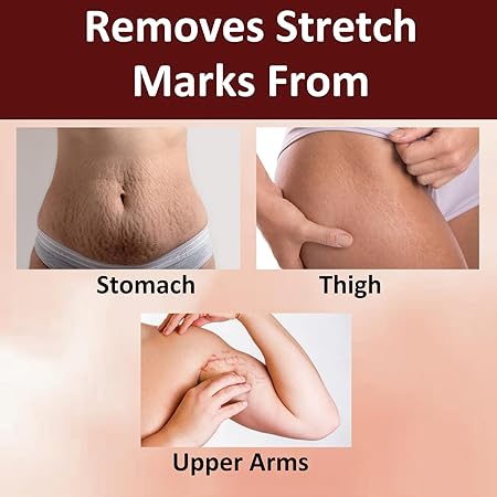 Stretch Mark Repair Cream for Radiant, Smooth Skin"